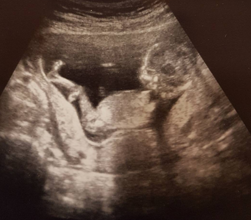 大龄客人赴美国试管婴儿代孕二胎顺利得子 QQ截图20170818144729 - 大龄客人赴美国试管婴儿代孕二胎顺利得子